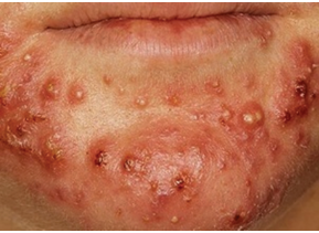 A Review on the Fabrication and Characterization of Anti ACNE Gel for Herbal Plants