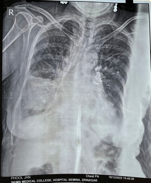 Phantom Tumor of the Lung: A Forgotten Masquerader of Malignant Lung Mass