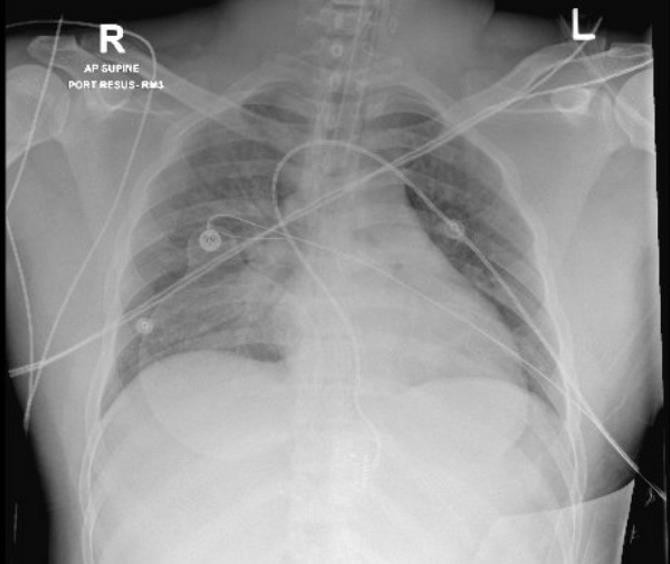 Acetamiprid Poisoning: A Case Report of Self- Poisoning with an Acetamiprid-Containing Insecticide