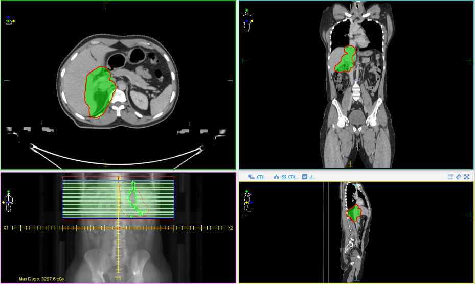Extranodal Primary Adrenal Lymphoma – A Case Report