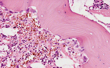 Outcome of Multiple Myeloma in the Elderly with the use of Bortezomib in Comparison to Old Combinati...