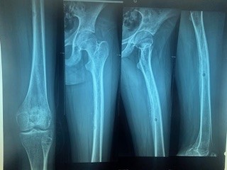 Pancreatic Metastasis as the Initial Presentation of a High-Grade Femoral Osteosarcoma in an Adolesc...