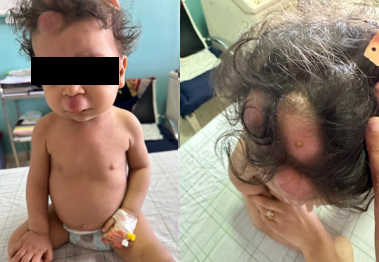 Subcutaneous Nodules Revealing Acute Lymphoblastic Leukemia in an Infant: A Case Report and Literatu...