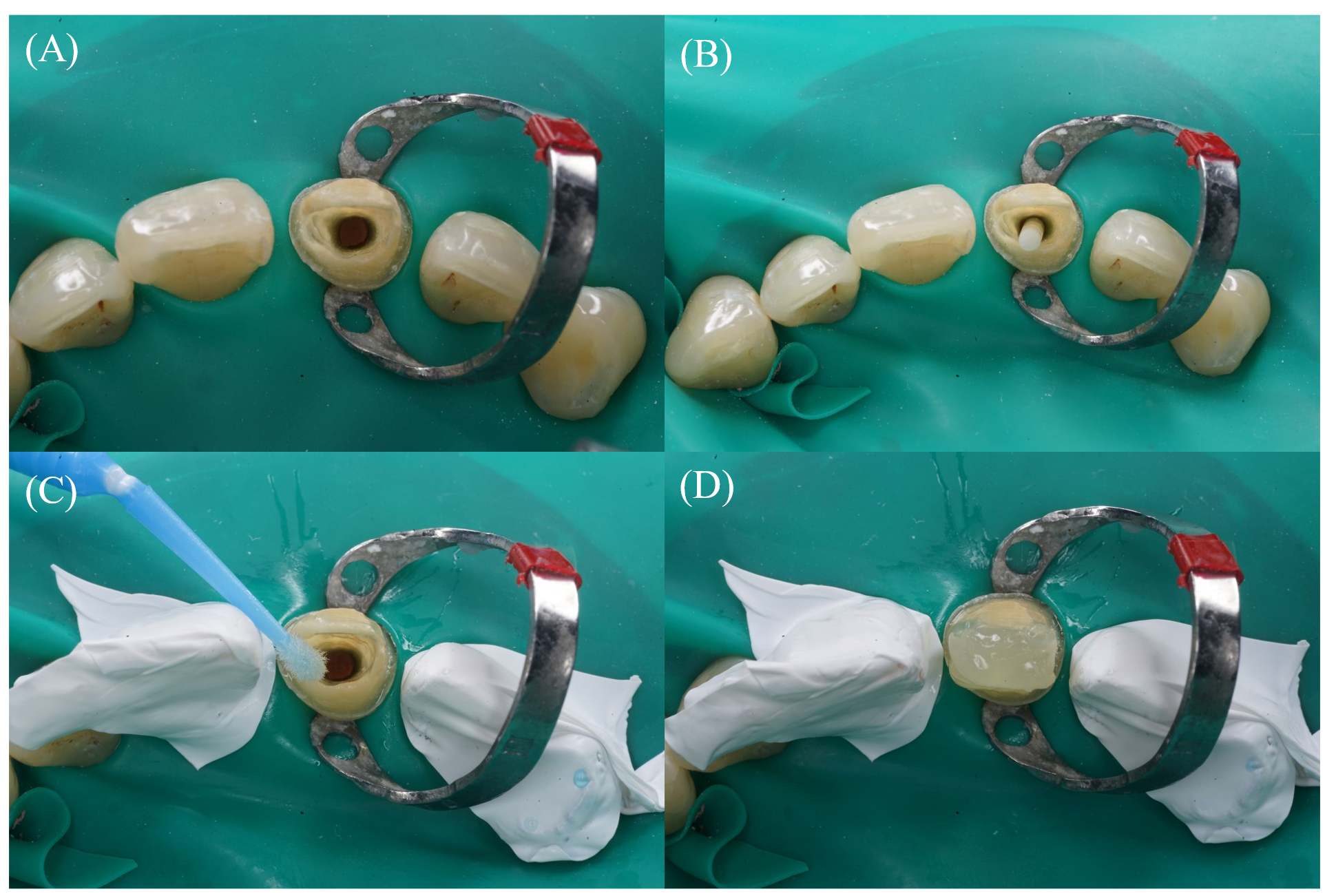 Restoration of Endodontically Treated Tooth with Short Fiber-Reinforced Composite and Glass Fiber Po...